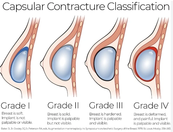 Baker Classification